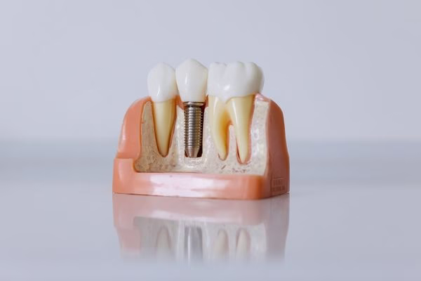Implantes dentales